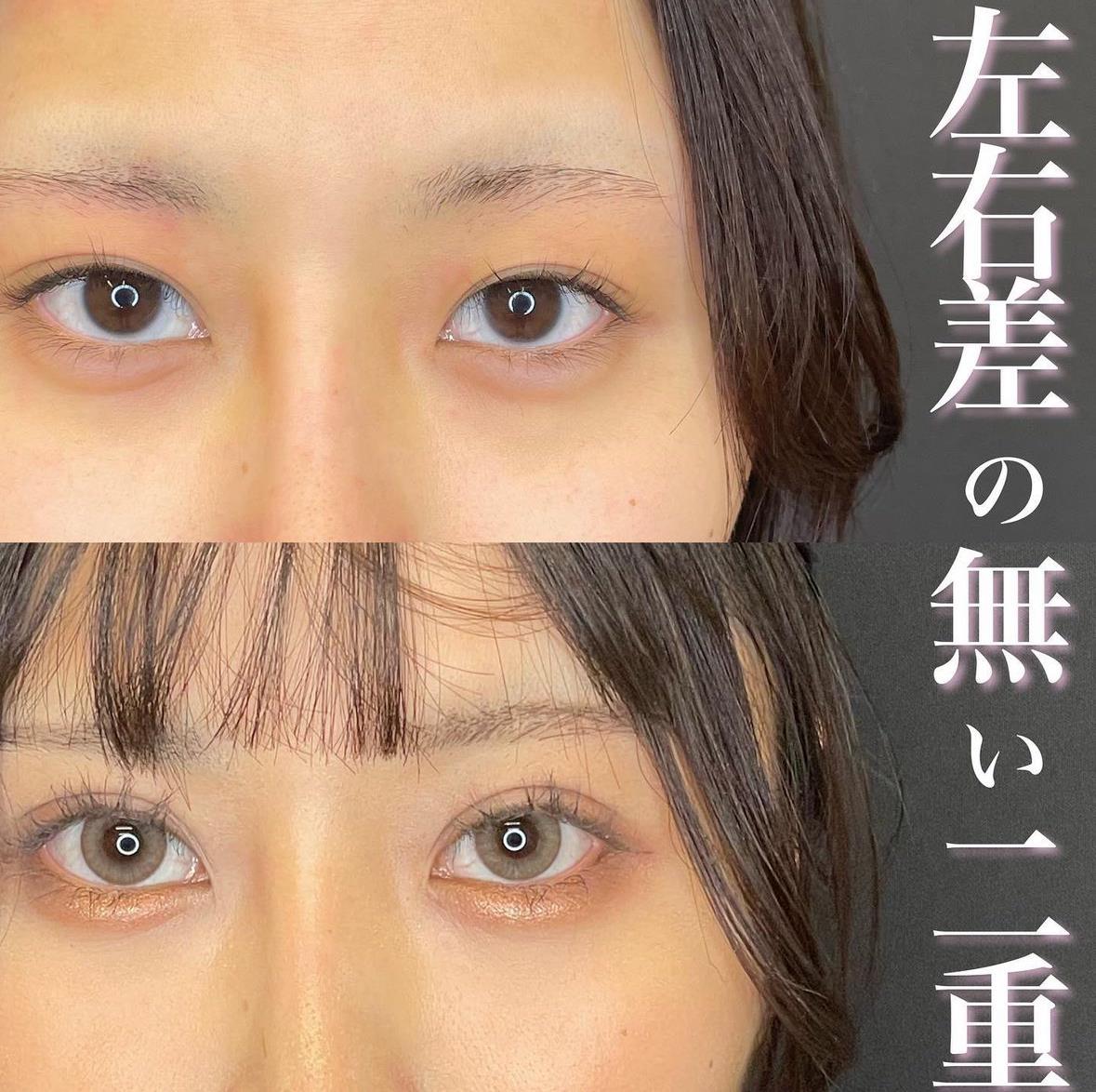 二重埋没