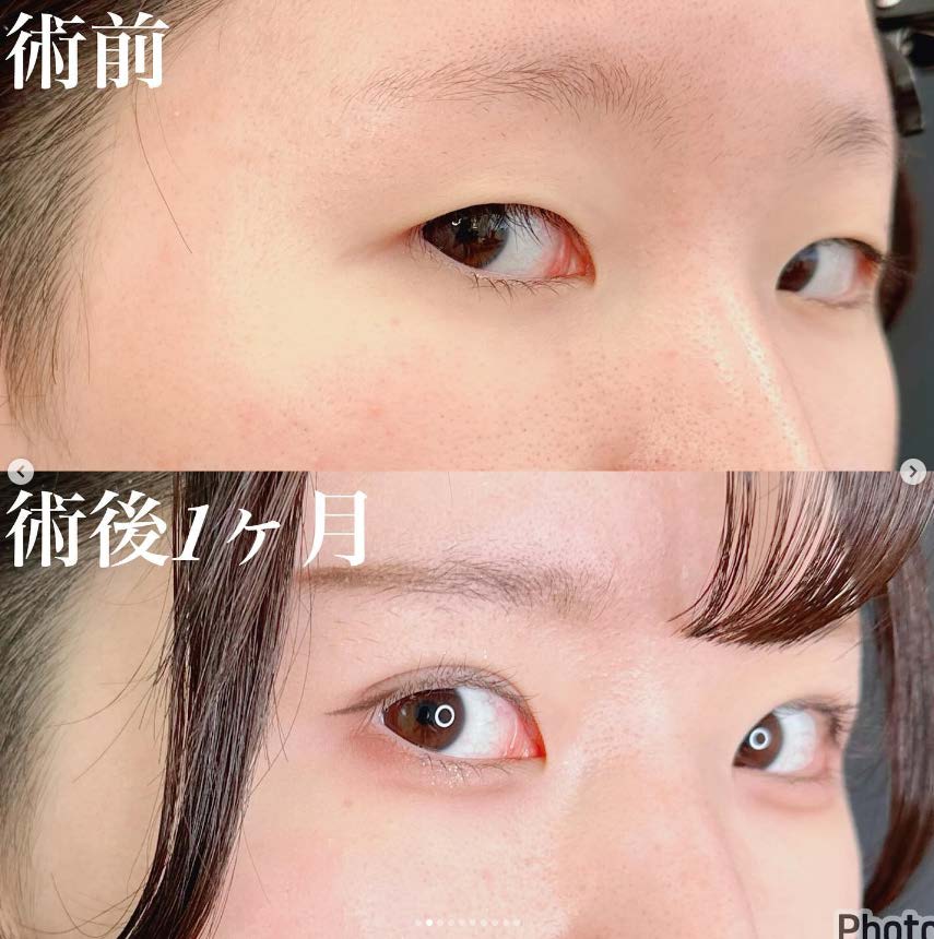 二重埋没