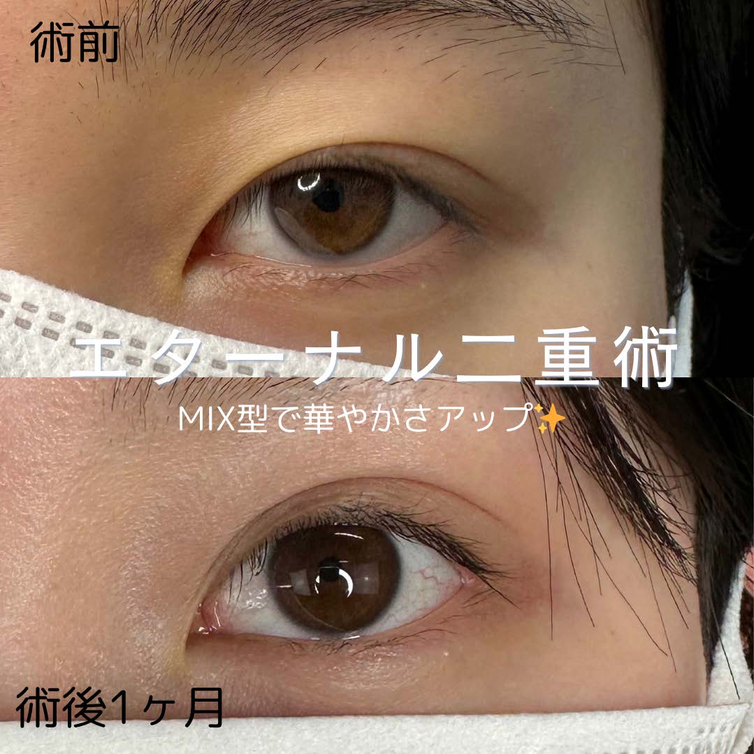 二重埋没
