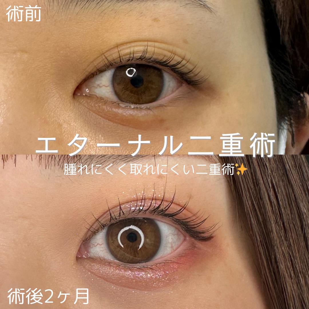 二重埋没