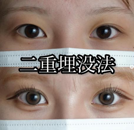 二重埋没