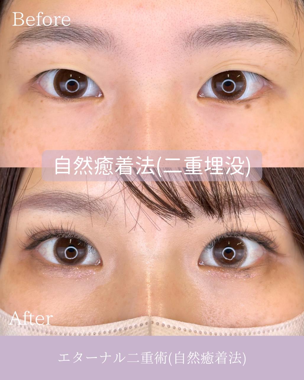 二重埋没