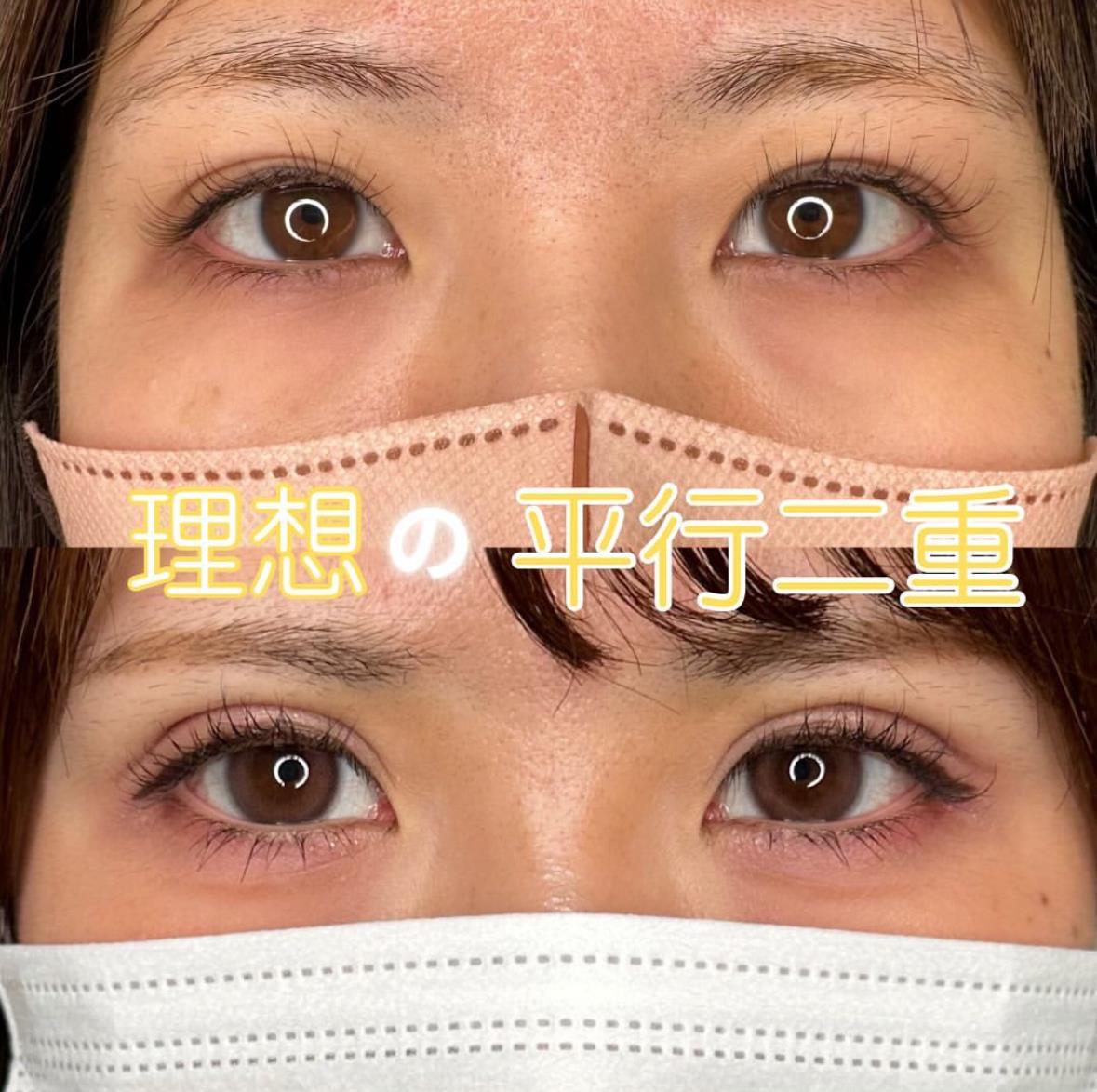 二重埋没