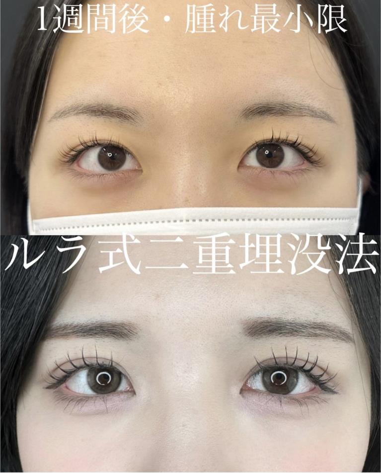 二重埋没