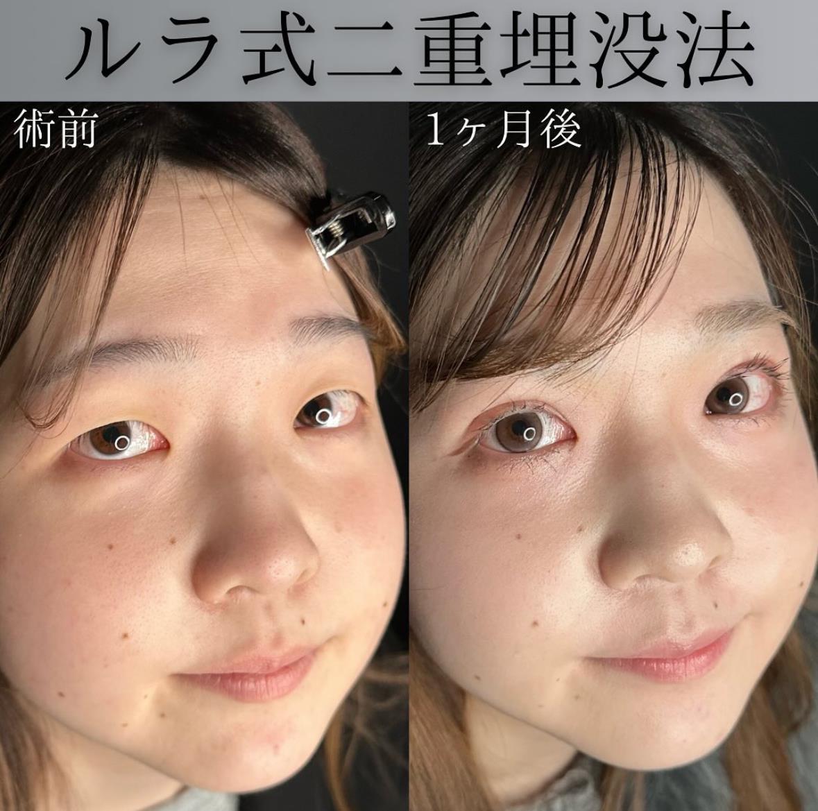 二重埋没