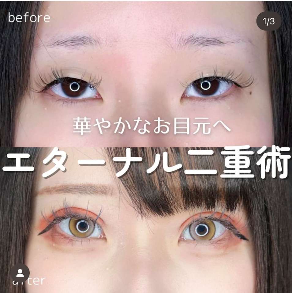 二重埋没