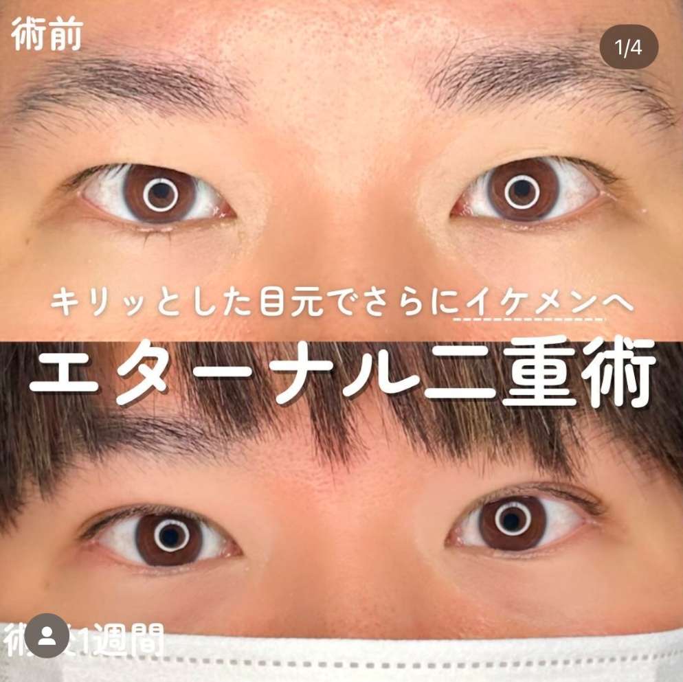 二重埋没