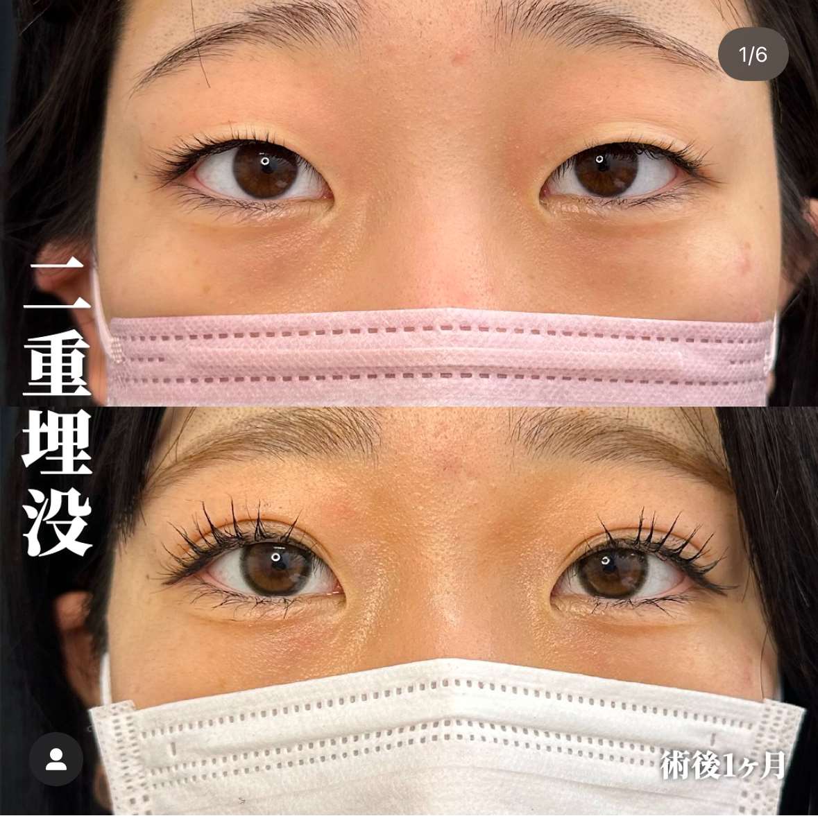 二重埋没