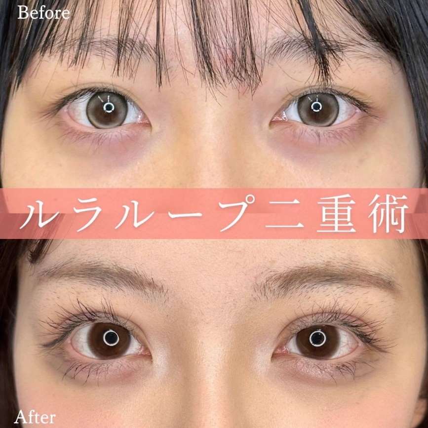 二重埋没