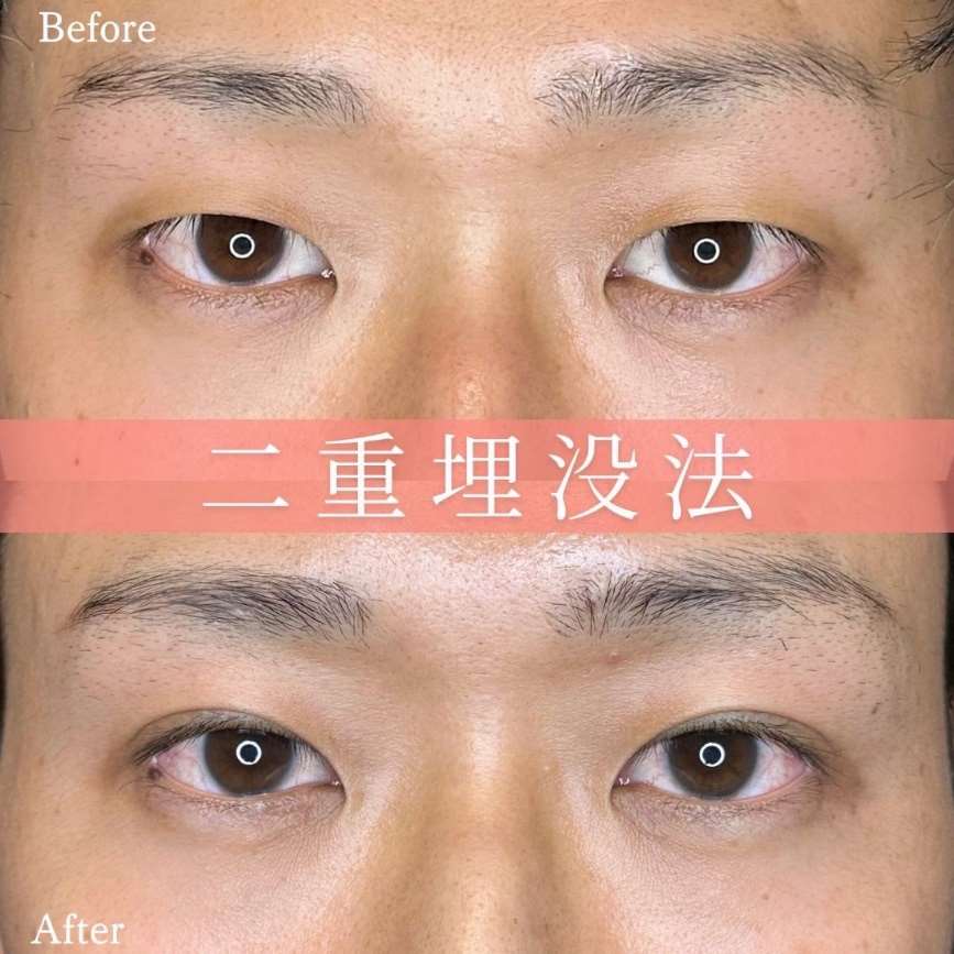 二重埋没