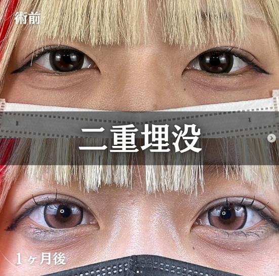 二重埋没