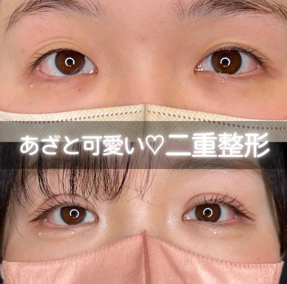 二重埋没