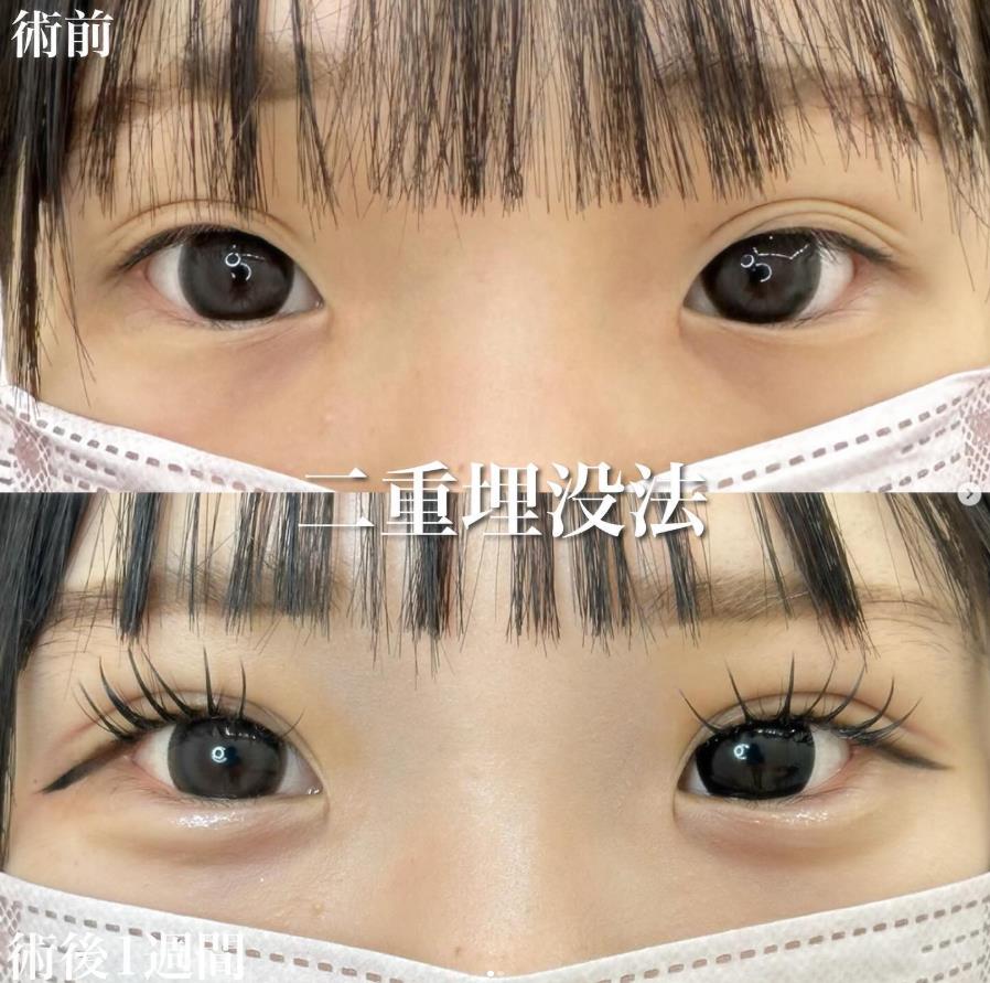 二重埋没