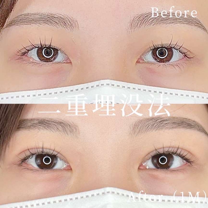 二重埋没