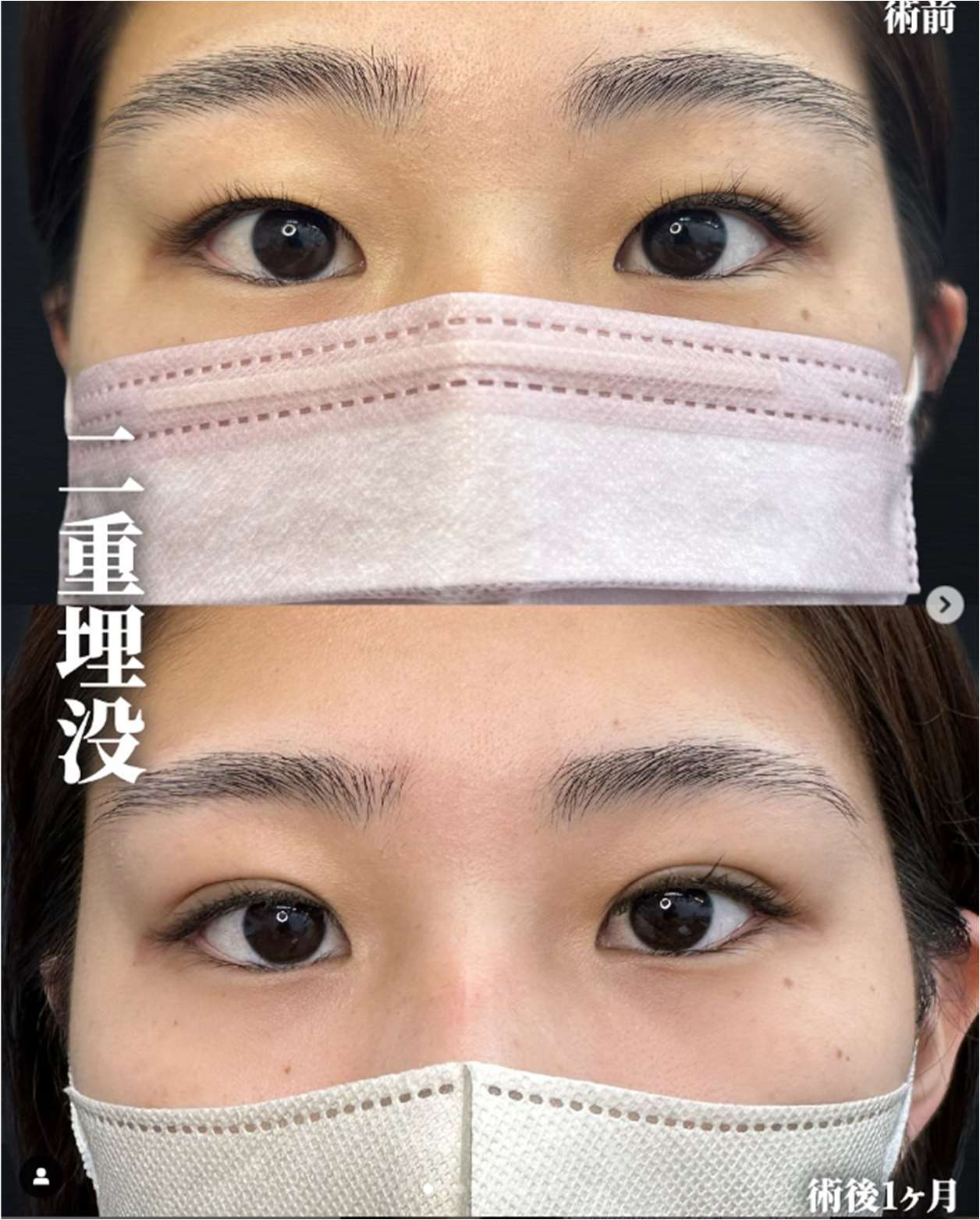 二重埋没