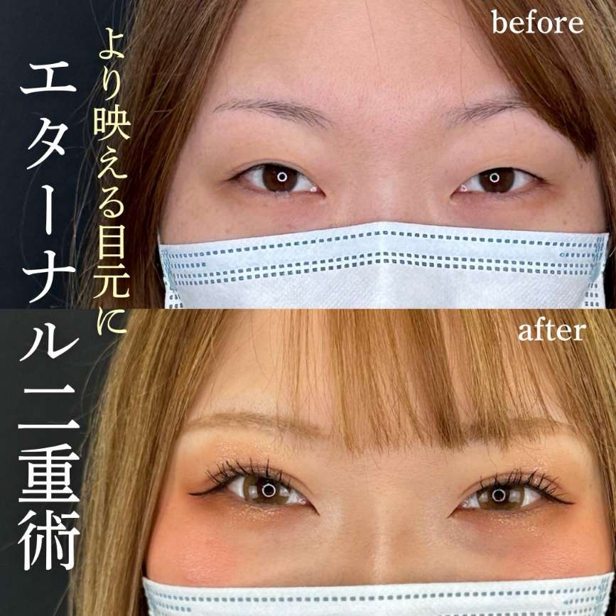 二重埋没