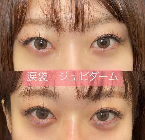 涙袋ヒアルロン酸の症例写真