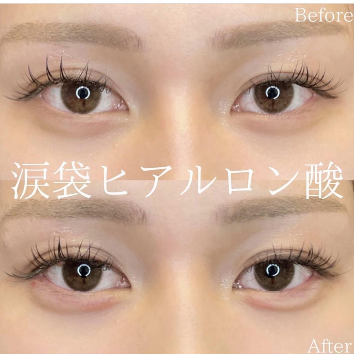 涙袋ヒアルロン酸の症例写真