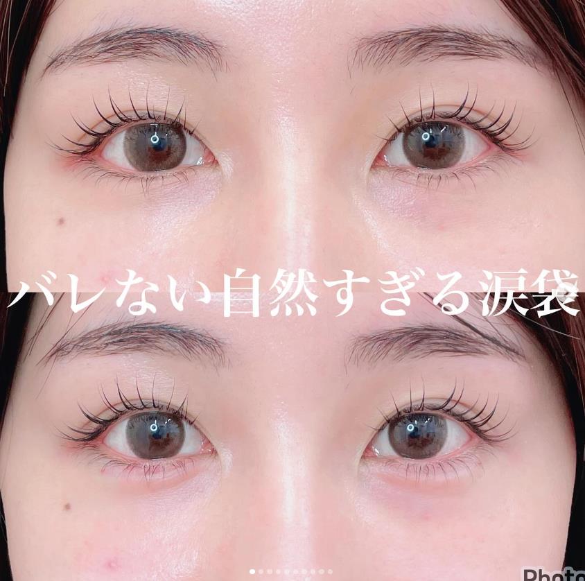 涙袋ヒアルロン酸の症例写真