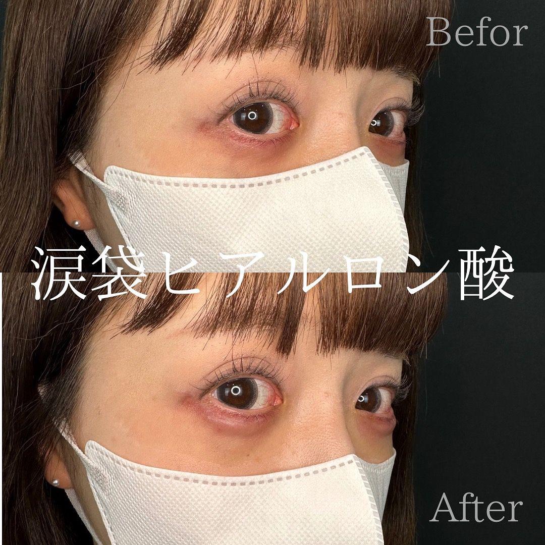 涙袋ヒアルロン酸の症例写真