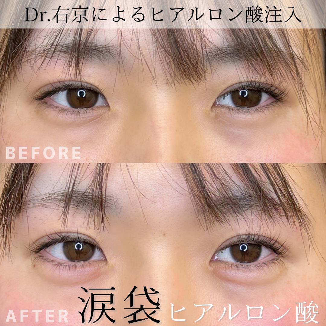 涙袋ヒアルロン酸の症例写真