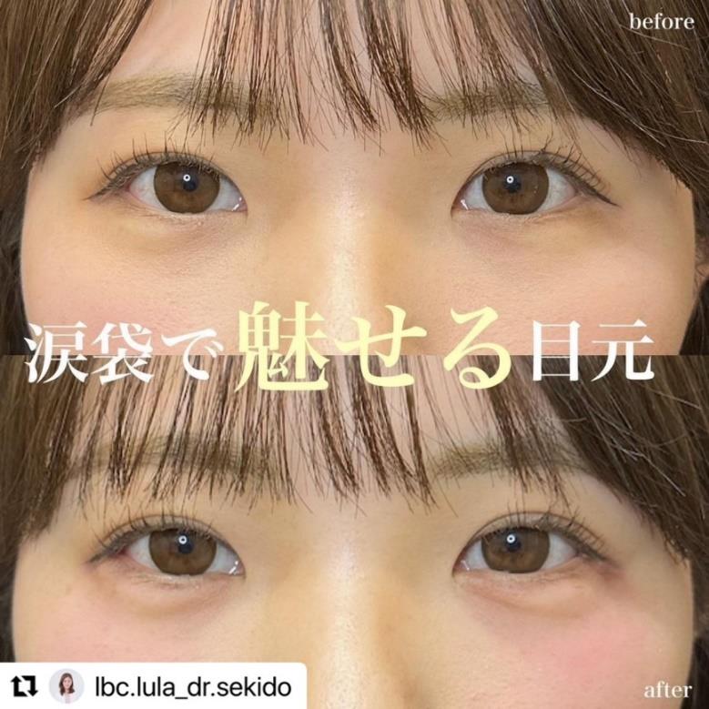 涙袋ヒアルロン酸の症例写真