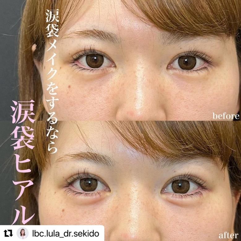涙袋ヒアルロン酸の症例写真