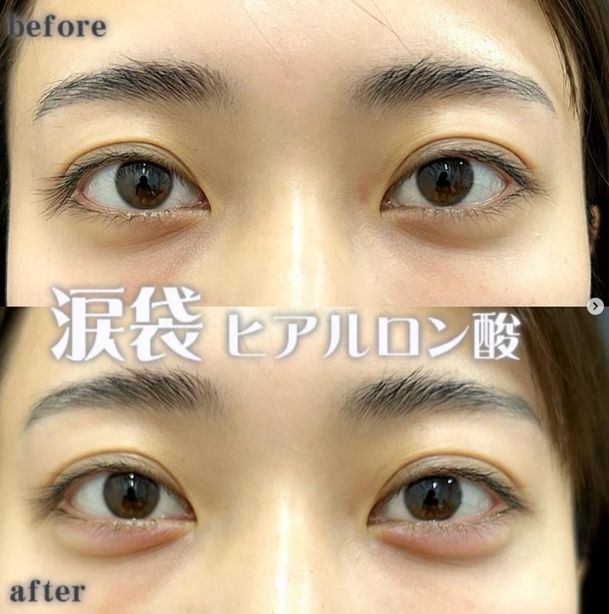 涙袋ヒアルロン酸の症例写真