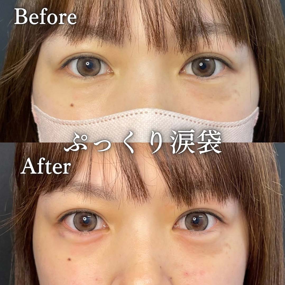 涙袋ヒアルロン酸の症例写真