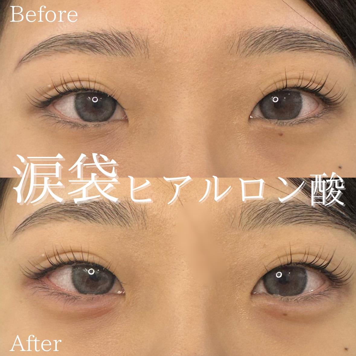 涙袋ヒアルロン酸の症例写真