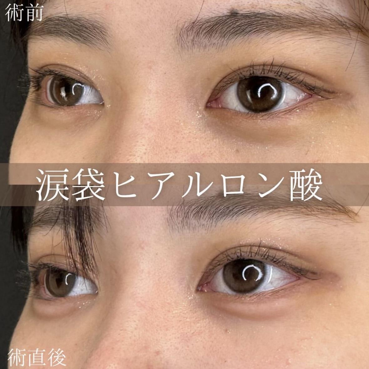 涙袋ヒアルロン酸の症例写真