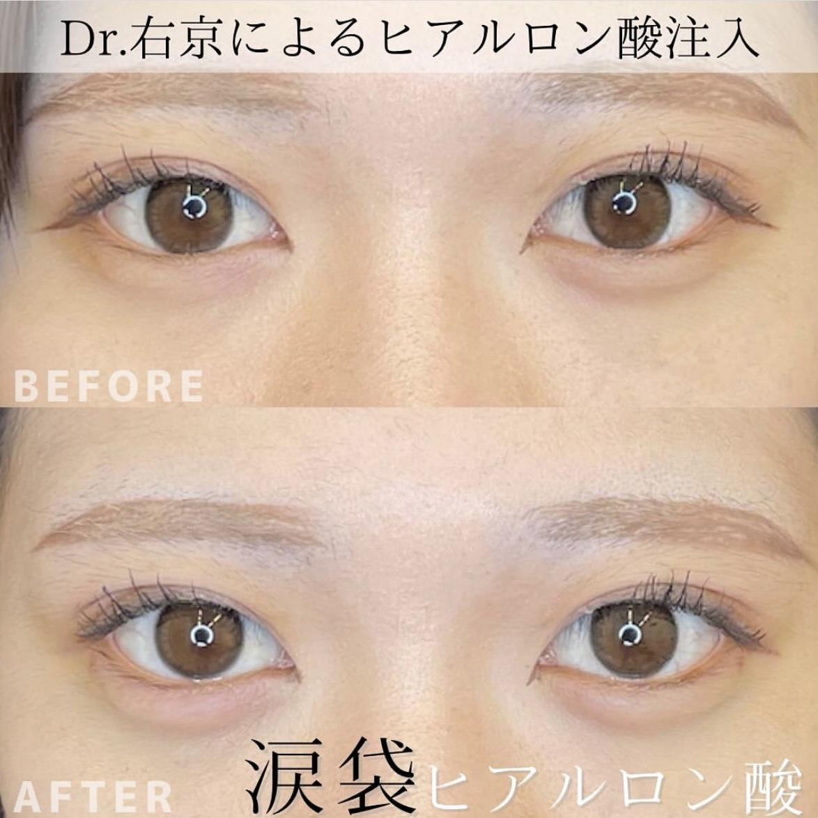 涙袋ヒアルロン酸の症例写真