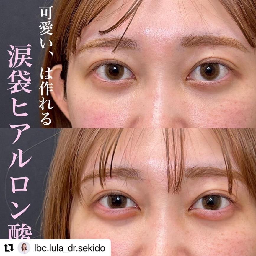 涙袋ヒアルロン酸の症例写真