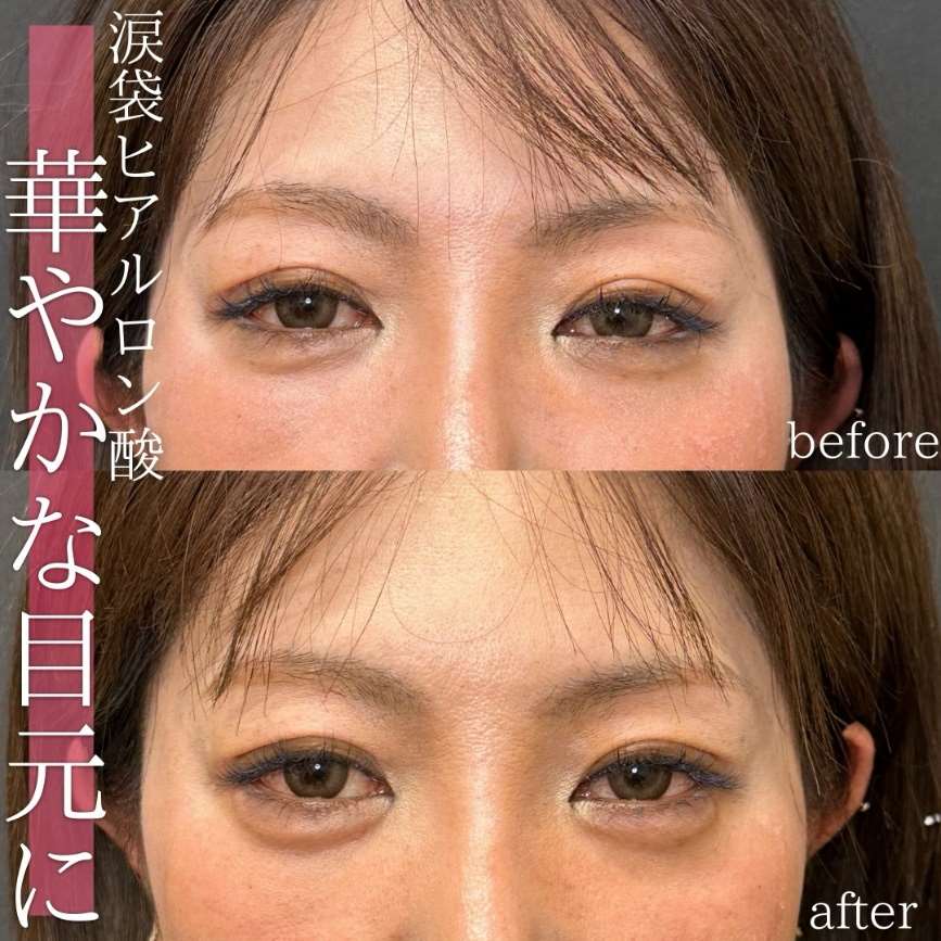 涙袋ヒアルロン酸の症例写真