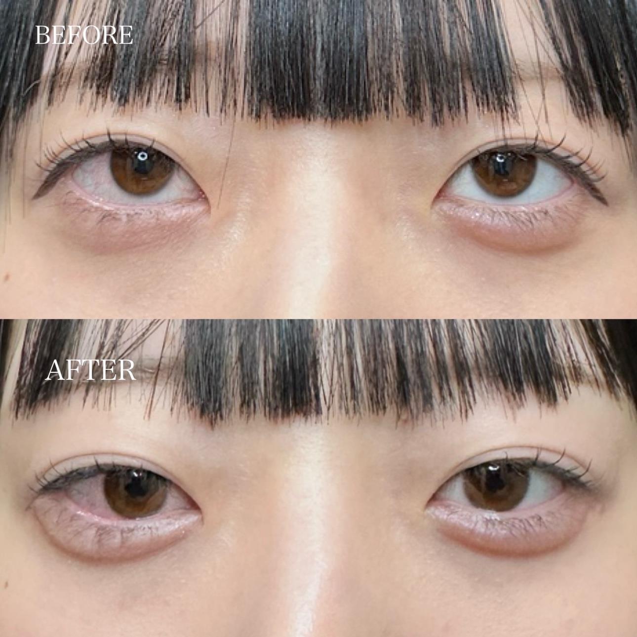 涙袋ヒアルロン酸の症例写真