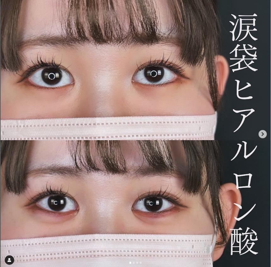 涙袋ヒアルロン酸の症例写真