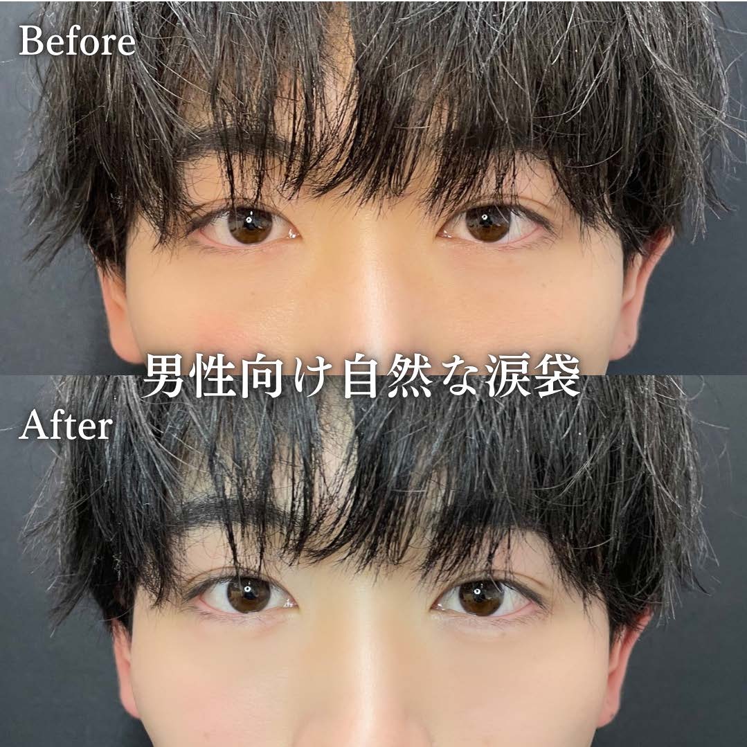 涙袋ヒアルロン酸の症例写真