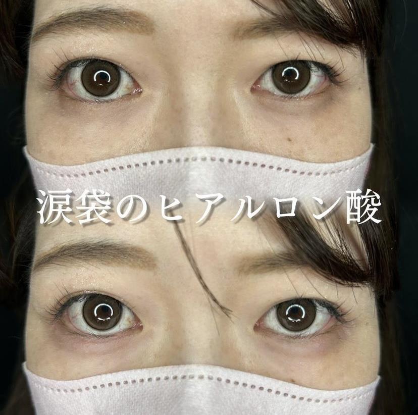 涙袋ヒアルロン酸の症例写真
