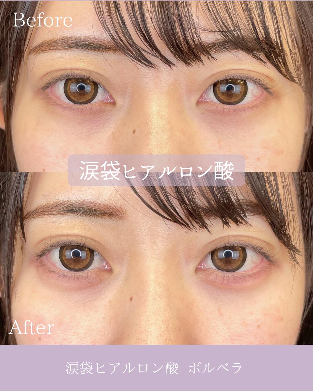 涙袋ヒアルロン酸の症例写真