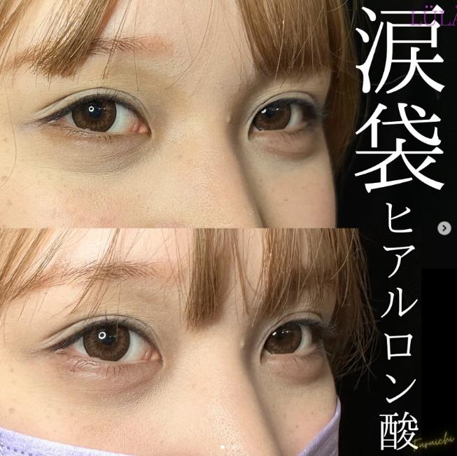 涙袋ヒアルロン酸の症例写真