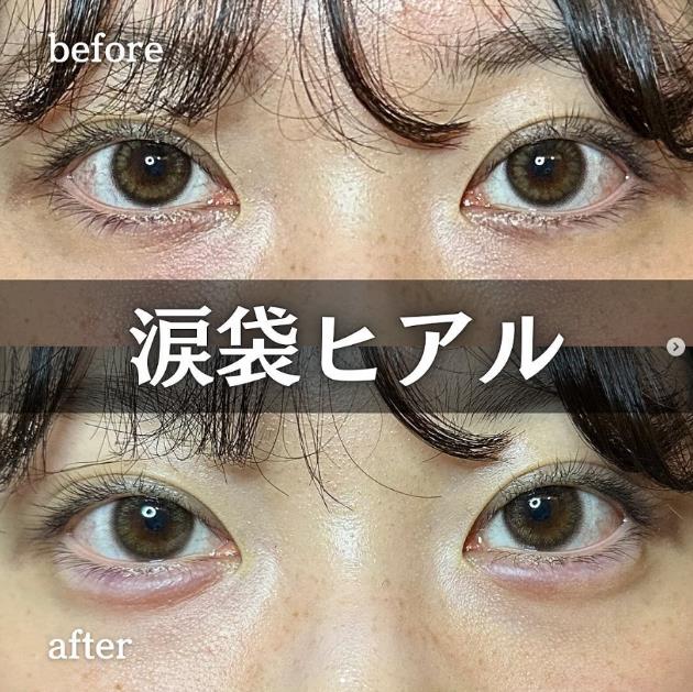 涙袋ヒアルロン酸の症例写真