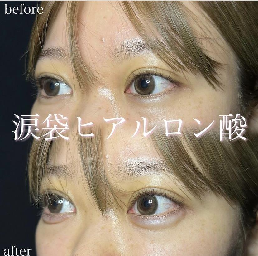 涙袋ヒアルロン酸の症例写真