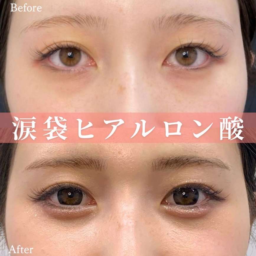 涙袋ヒアルロン酸の症例写真