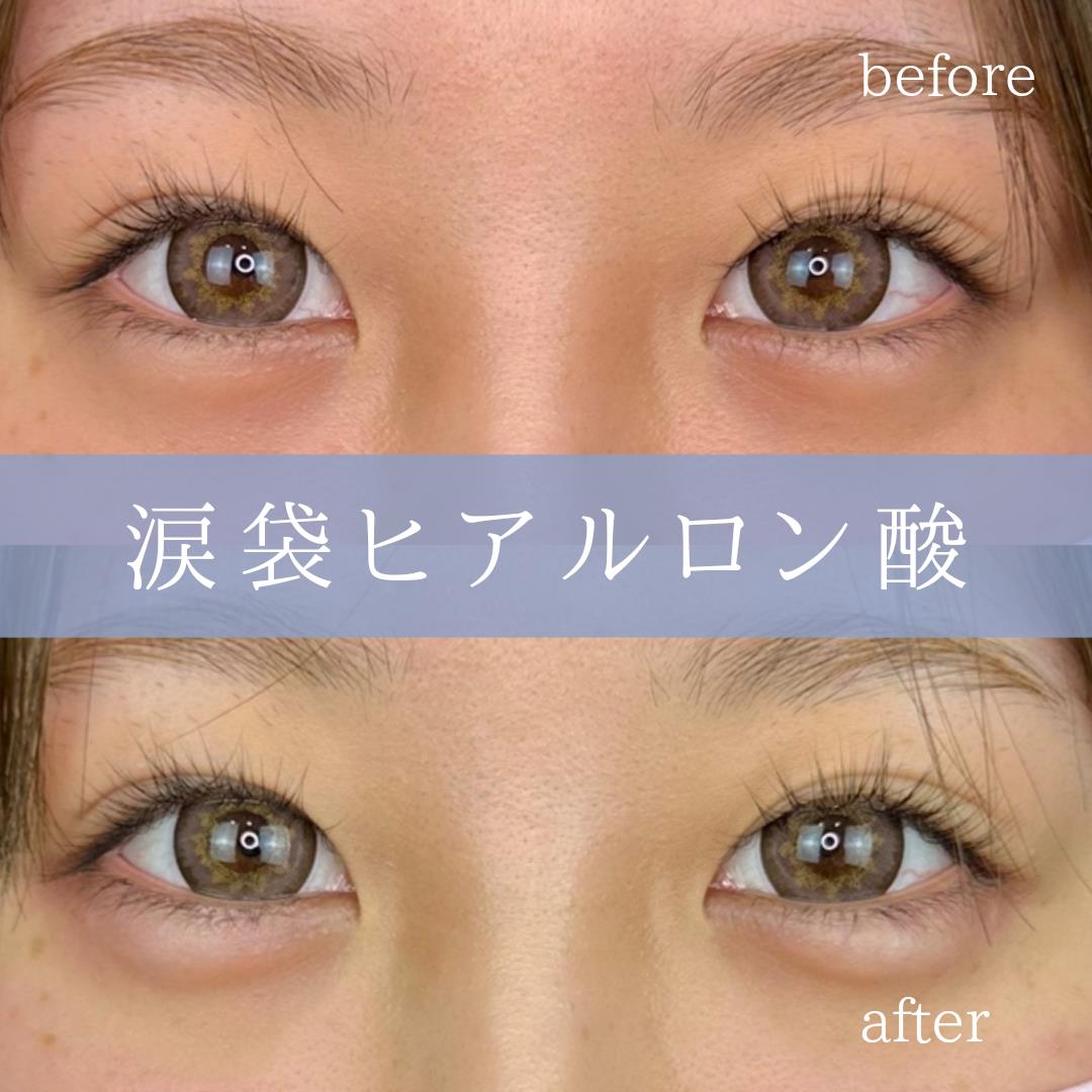 涙袋ヒアルロン酸の症例写真