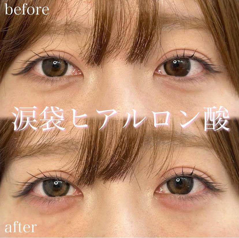涙袋ヒアルロン酸の症例写真