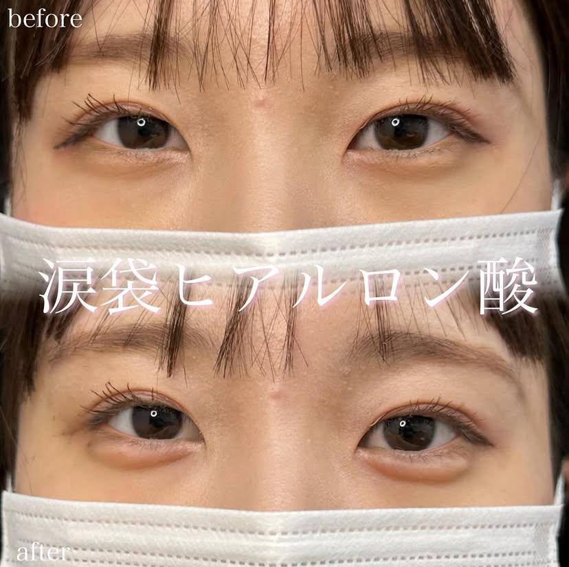 涙袋ヒアルロン酸の症例写真