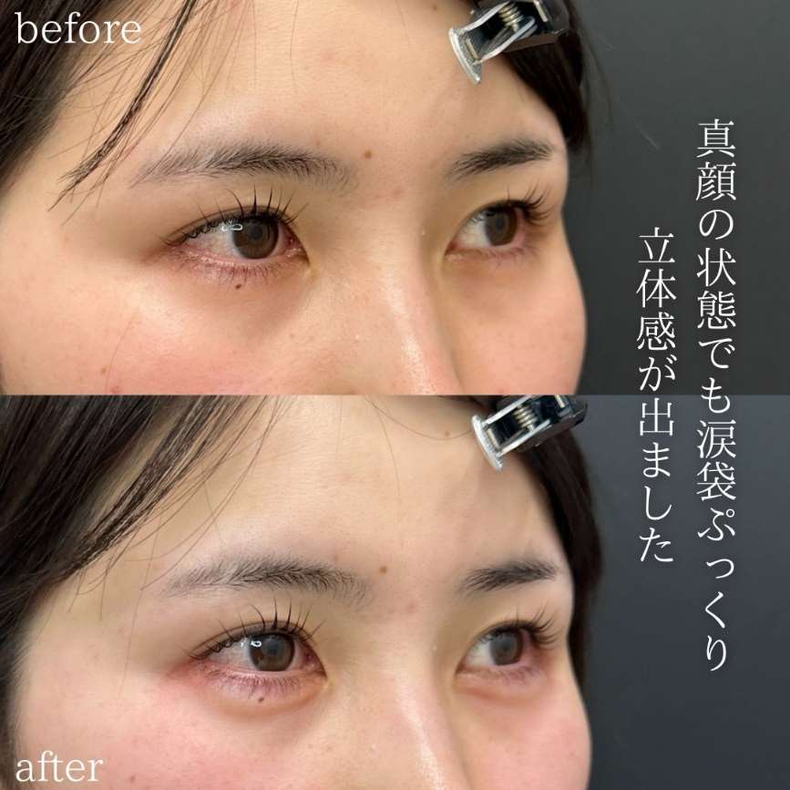 涙袋ヒアルロン酸の症例写真