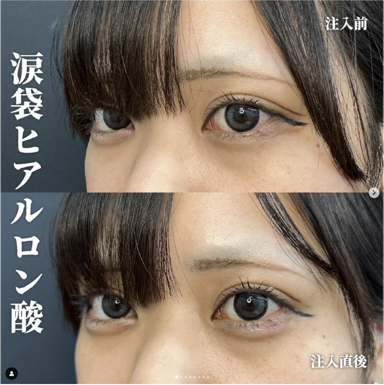 涙袋ヒアルロン酸の症例写真