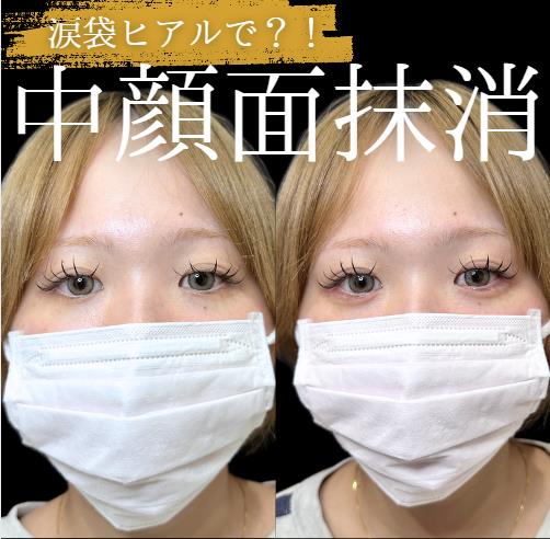 涙袋ヒアルロン酸の症例写真