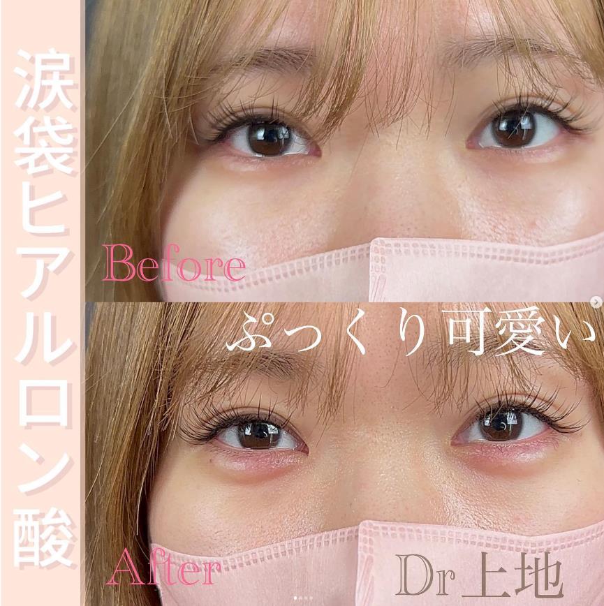 涙袋ヒアルロン酸の症例写真